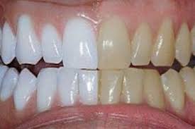 Do all teeth whiten?