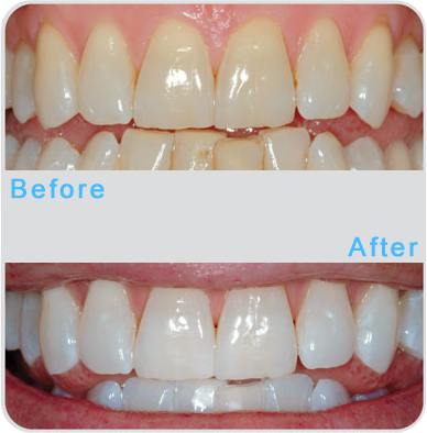 AT HOME PROFESSIONAL CUSTOM TEETH WHITENING SYSTEM